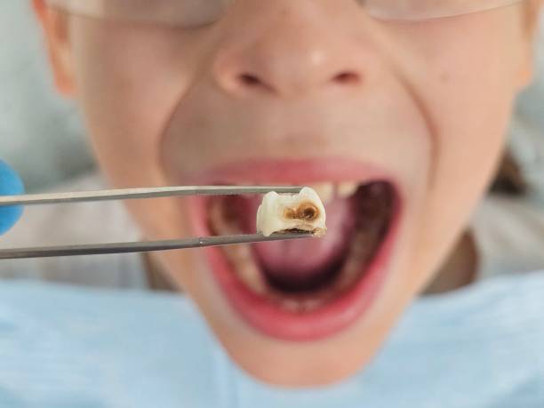 Best Emergency Tooth Extraction in Ballinger, TX